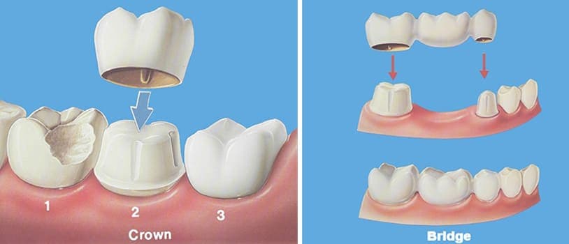 Best Crown & Bridges Treatments In PCMC