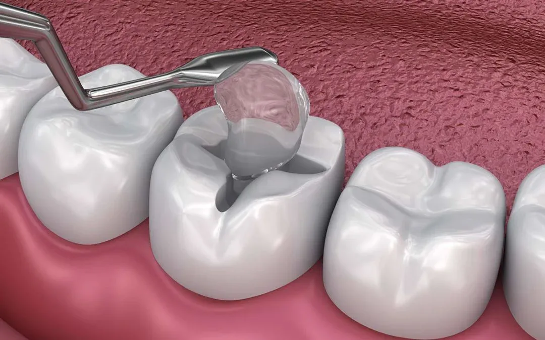 Best Fillings Treatments In Bhosari 