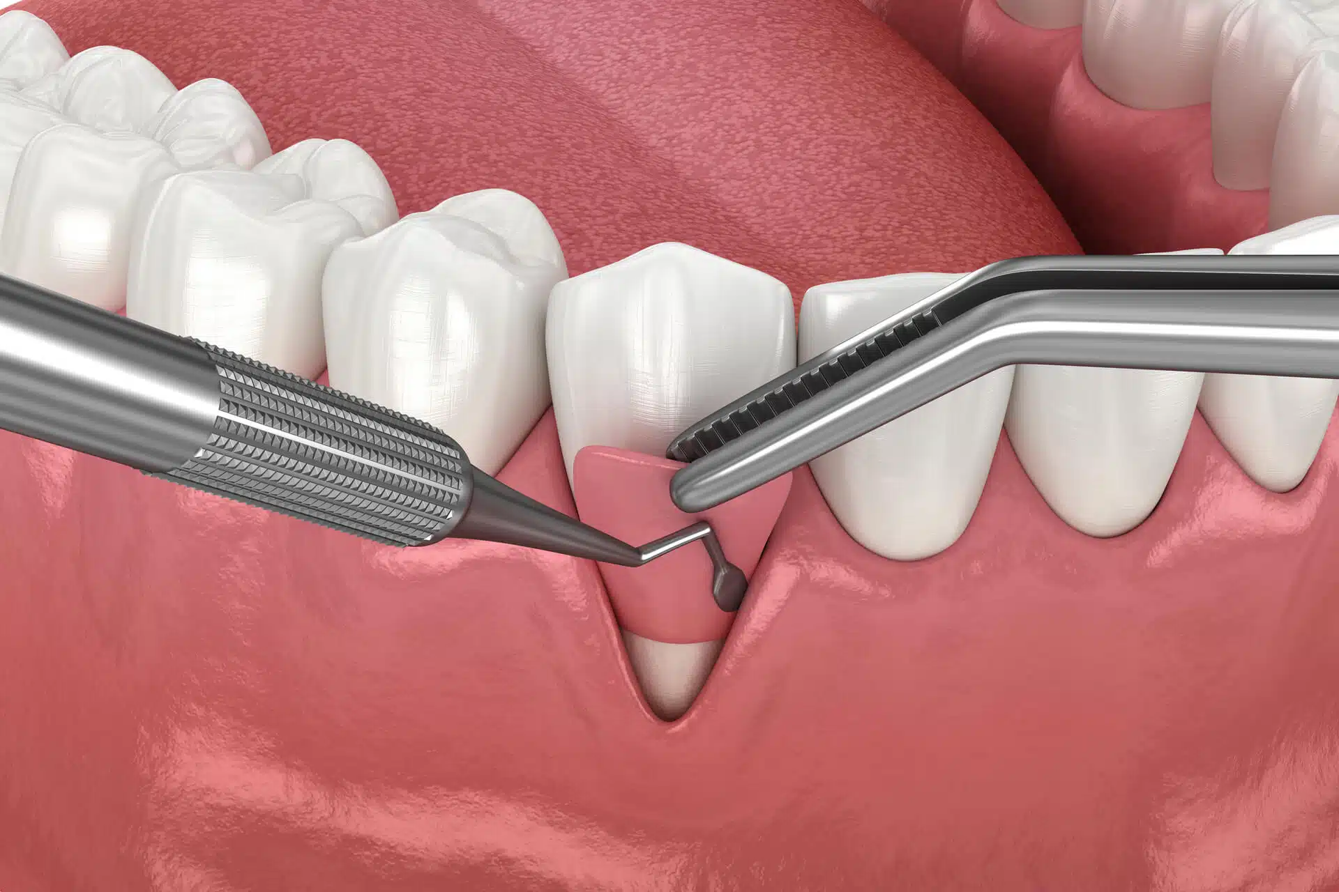 Best Gum Surgery Treatments In Bhosari