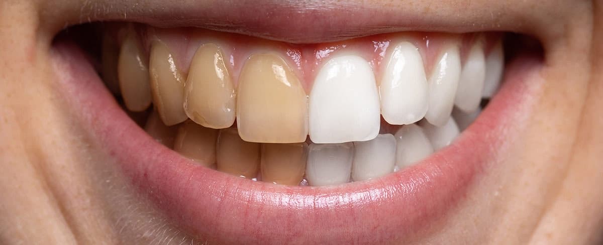Best Teeth Whitening Treatments In Bhosari