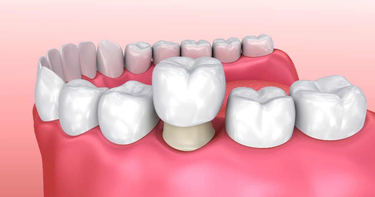 Best Dental Crowns Treatments in Bhosari