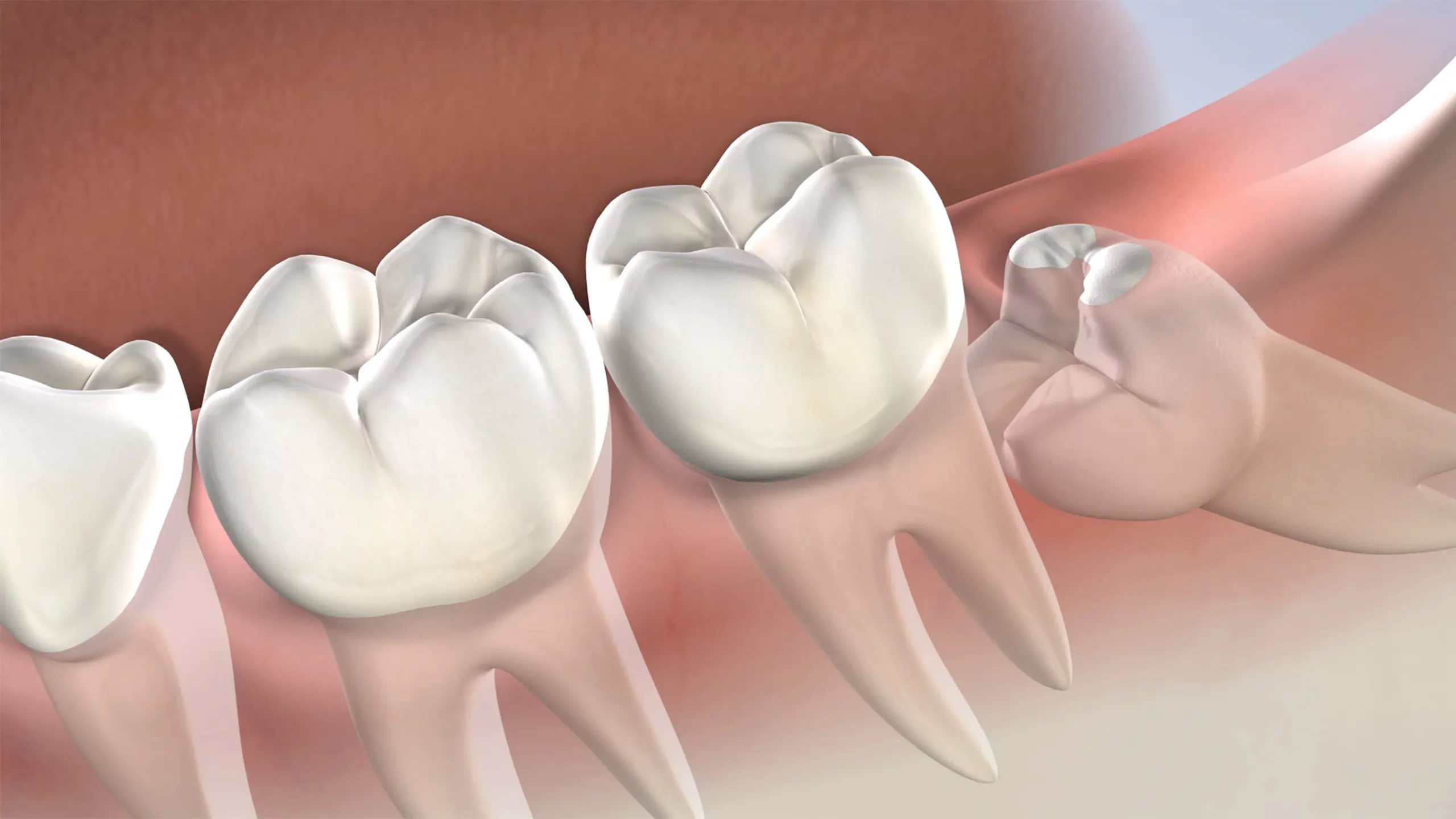 Best Wisdom Tooth Extraction Dentistry in PCMC