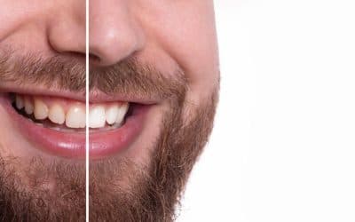 The Magic of Porcelain Veneers: Correcting Chips, Gaps, and Stains
