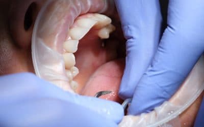 Painless Dentistry: How We Manage Dental Anxiety at Denteva