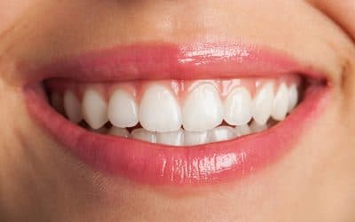 Teeth Whitening: Why Professional Treatment Beats At-Home Kits