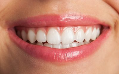 Teeth Whitening: Why Professional Treatment Beats At-Home Kits
