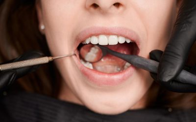 Essential Wisdom Tooth Extraction Recovery Guide: Post-Care Tips for PCMC Patients